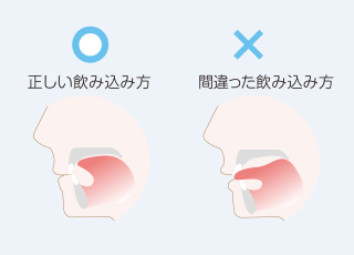 舌癖がある場合