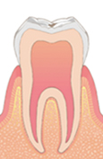 C0 （ごく初期のむし歯）
