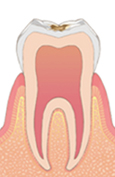 C1（エナメル質のむし歯）