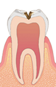 C2（象牙質のむし歯）