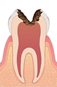 C3（神経まで達したむし歯）