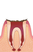 C4（歯根まで達したむし歯）