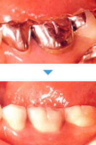 被せ物（クラウン）