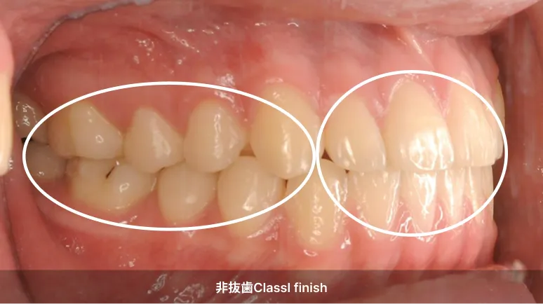 非抜歯ClassⅠ finish